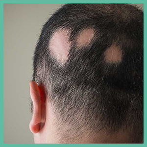 Alopecia-areata