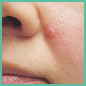 Basal0-cell-carcinoma