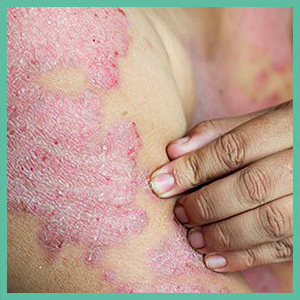 Psoriasis